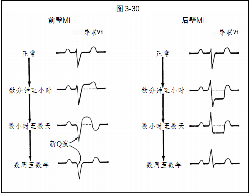 图文详解:心肌缺血和梗死的心电图