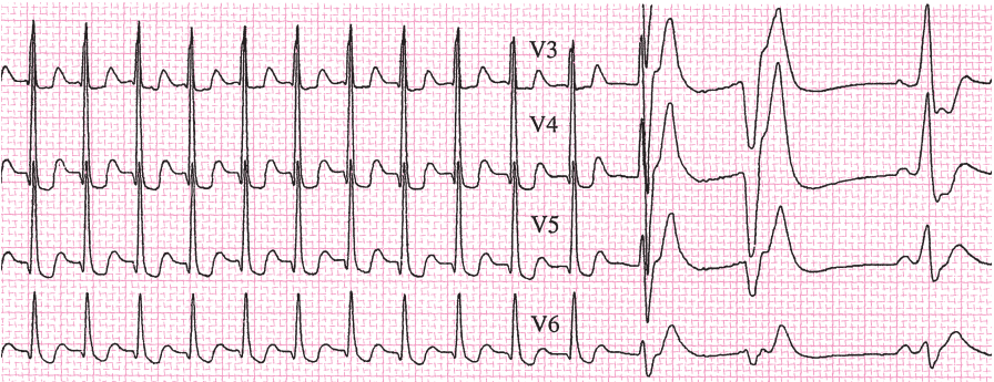 一文总结:预激综合征的心电图特点和诊治