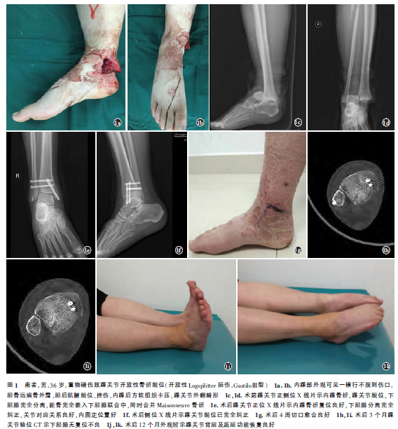 Ⅰ期清创内固定治疗踝关节开放性logsplitter损伤1例