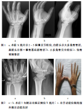 患者男性,25岁,因"创伤致左手疼痛,肿胀30min"入院.