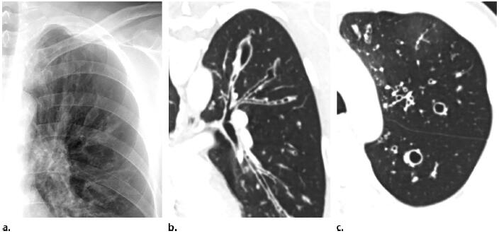 支气管扩张的影像特征有哪些?