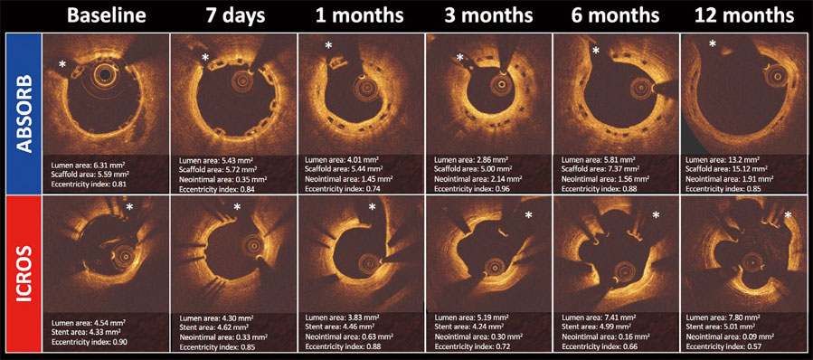 生物标志物联合OCT预测ACS患者再发冠脉事