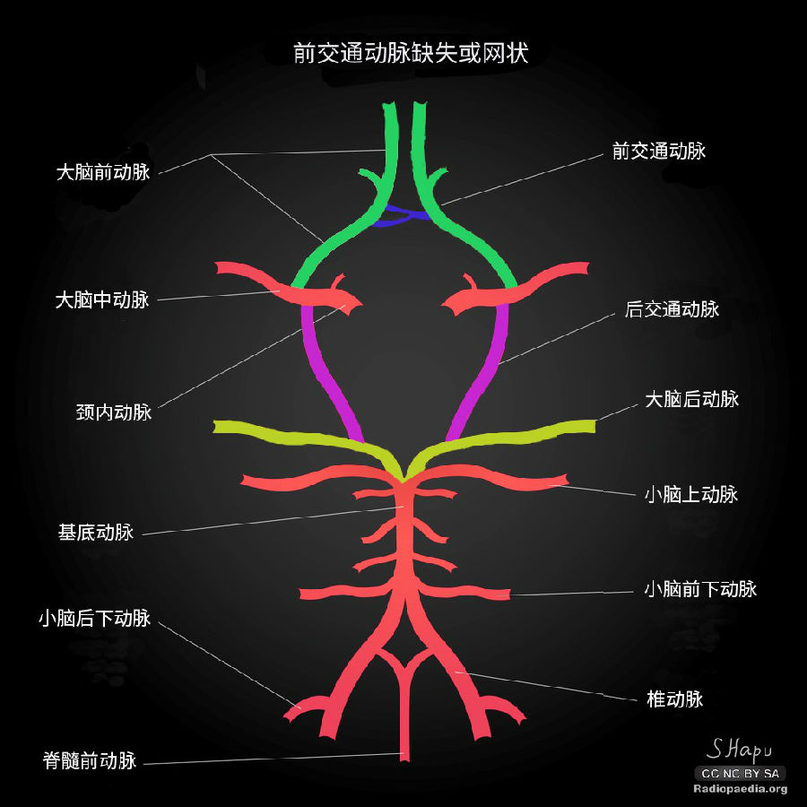 10%的willis环可见胚胎型大脑后动脉;6%的willis环由于缺少后交通动脉