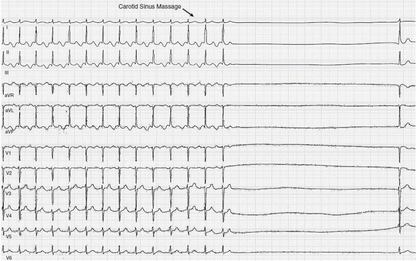 奇怪的心动过速,90%的医生猜错了答案
